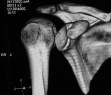 Shoulder Instability and Dislocations